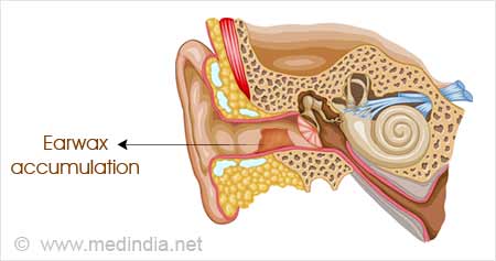 ear barotrauma home remedies