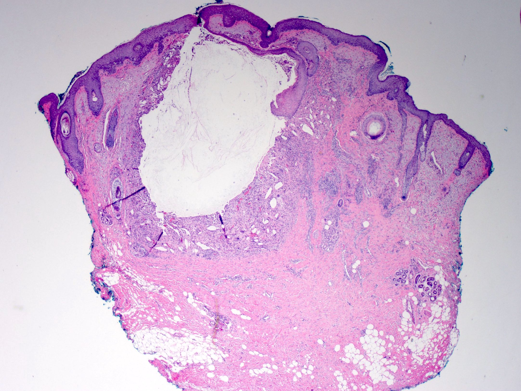 epidermoid cyst pathology outlines