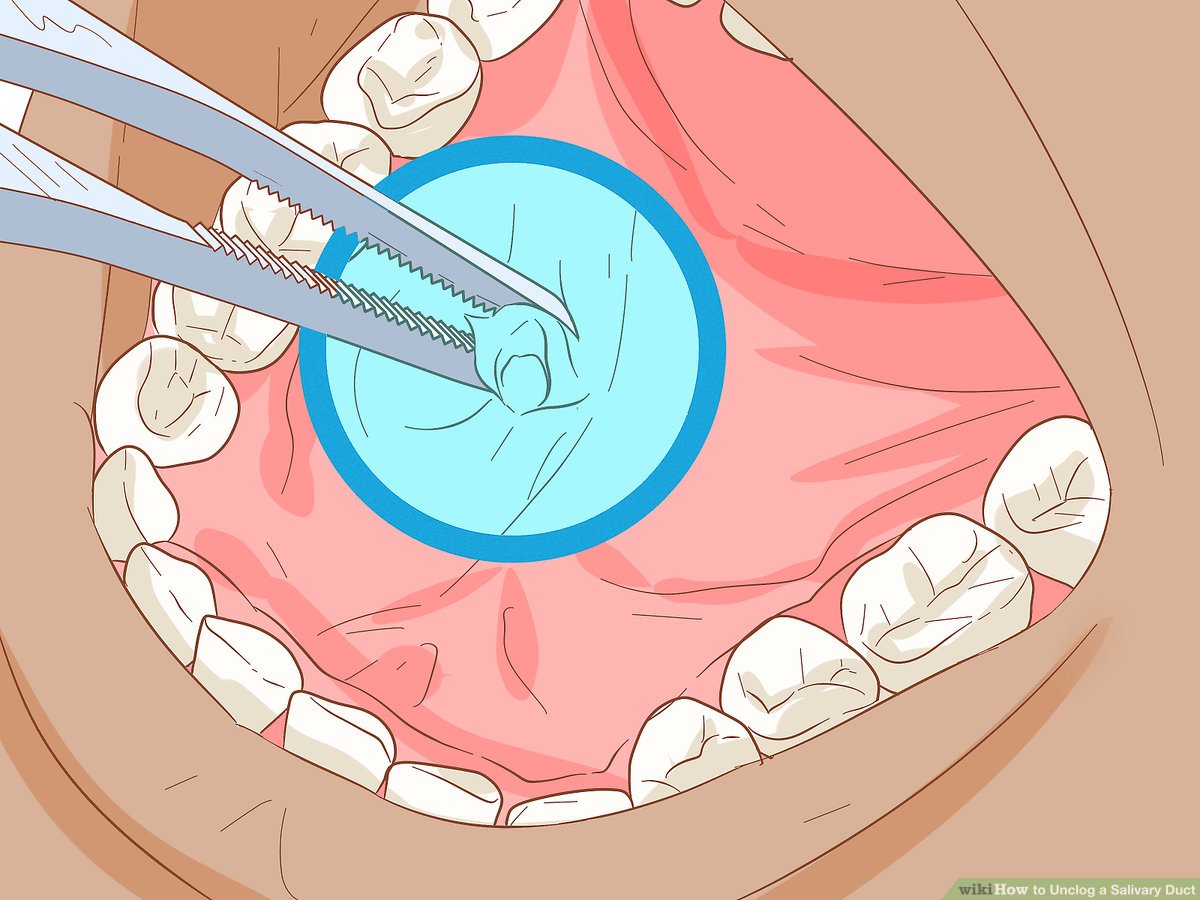 how to unclog salivary duct