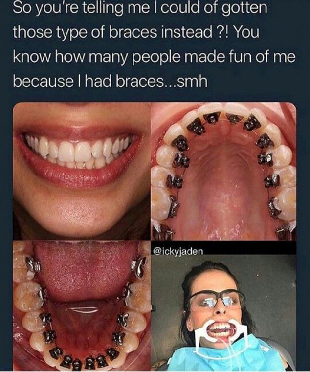 funny braces memes