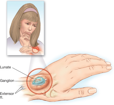 ganglion cyst icd 10