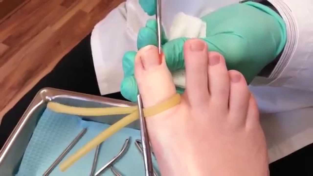 how to remove ingrown toenail youtube