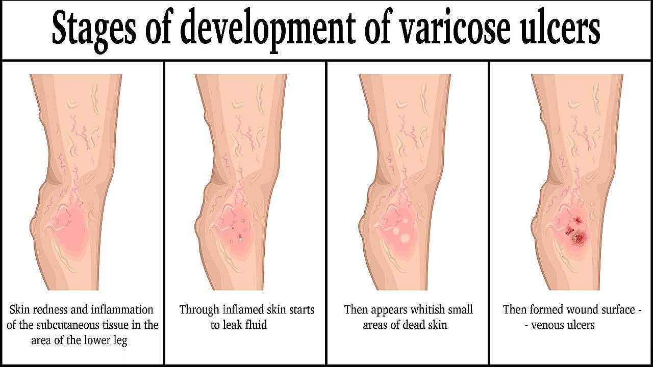 icd 10 venous stasis ulcer right lower leg