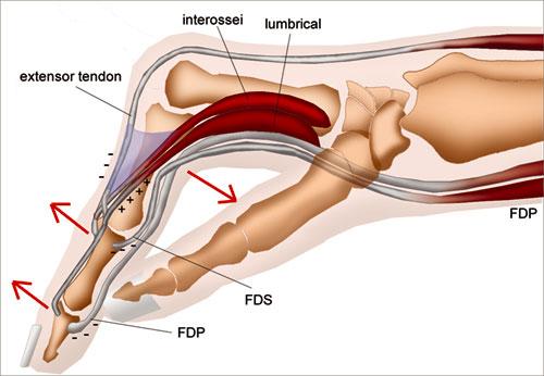 intrinsic plus deformity