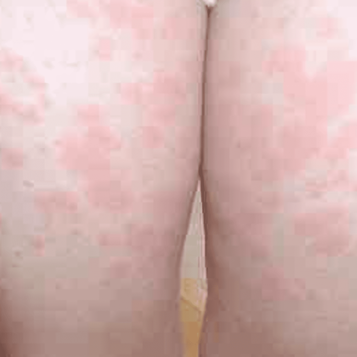 lamotrigine rash photos