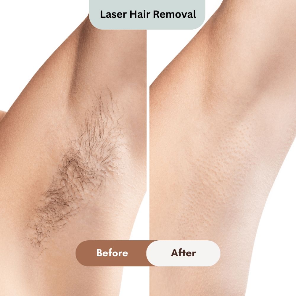 laser hair removal port moody