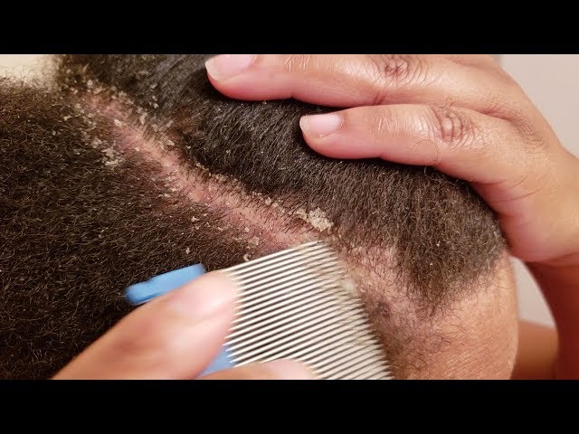 lice comb for dandruff