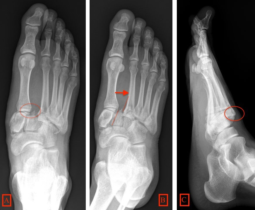 lisfranc fracture radiology