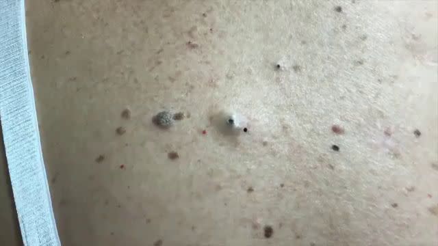 massive blackhead on back