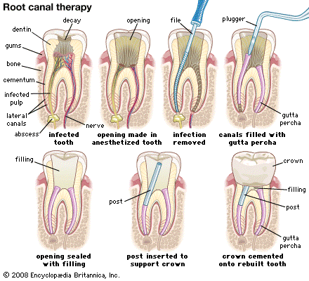 medicated filling vs root canal