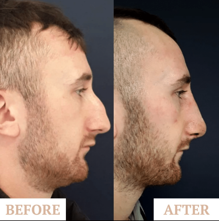 non surgical rhinoplasty leeds