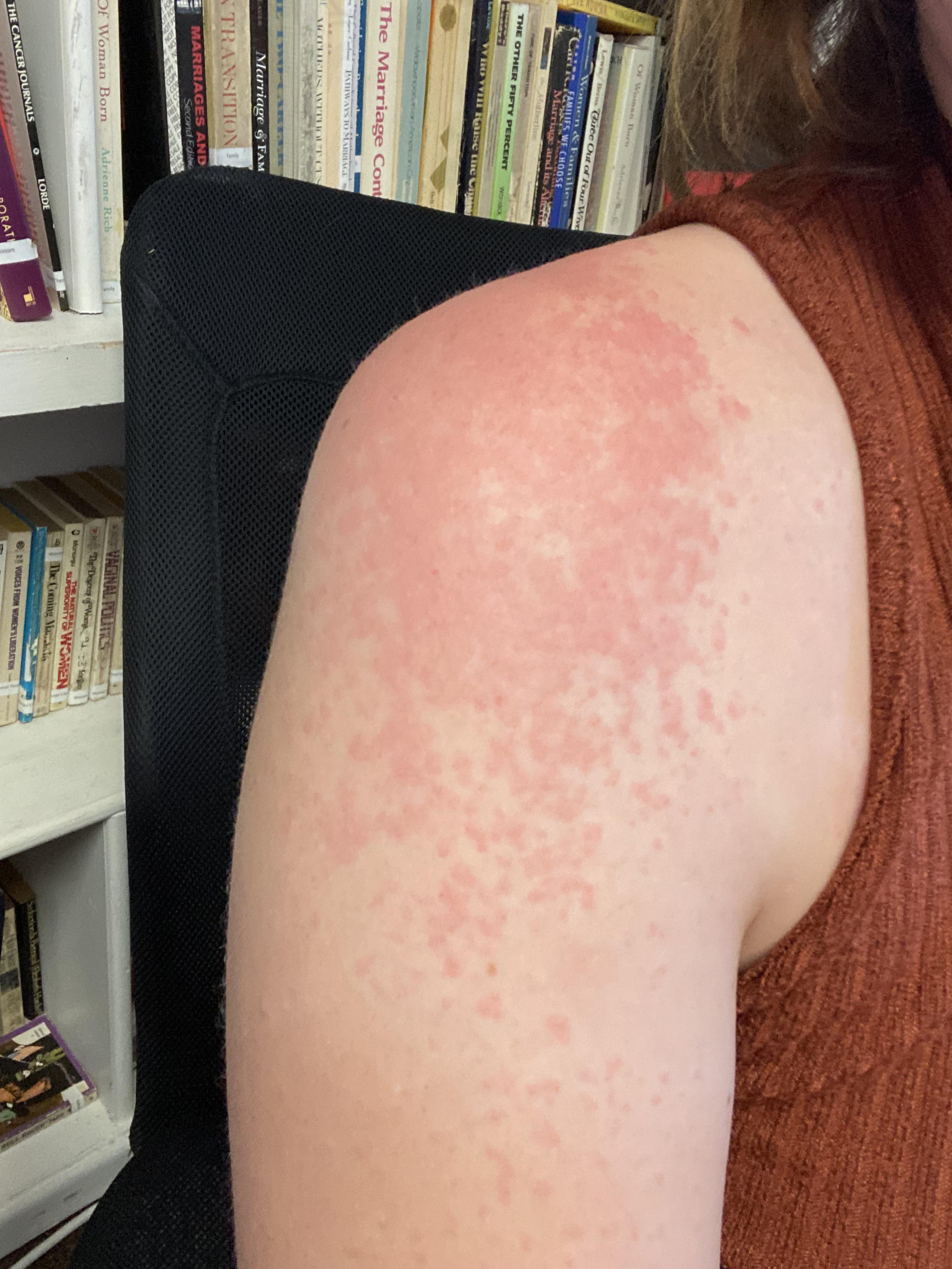 pictures of lamotrigine rash