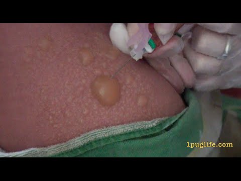 popping massive boils