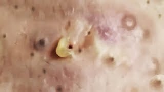 popping spots youtube