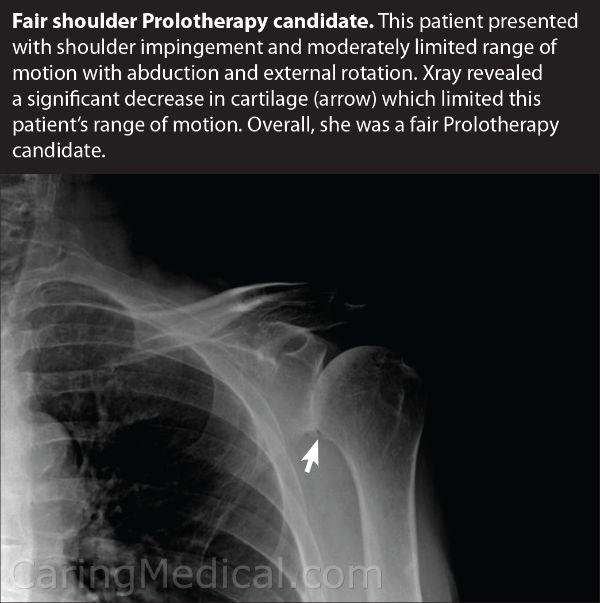 regret shoulder replacement surgery