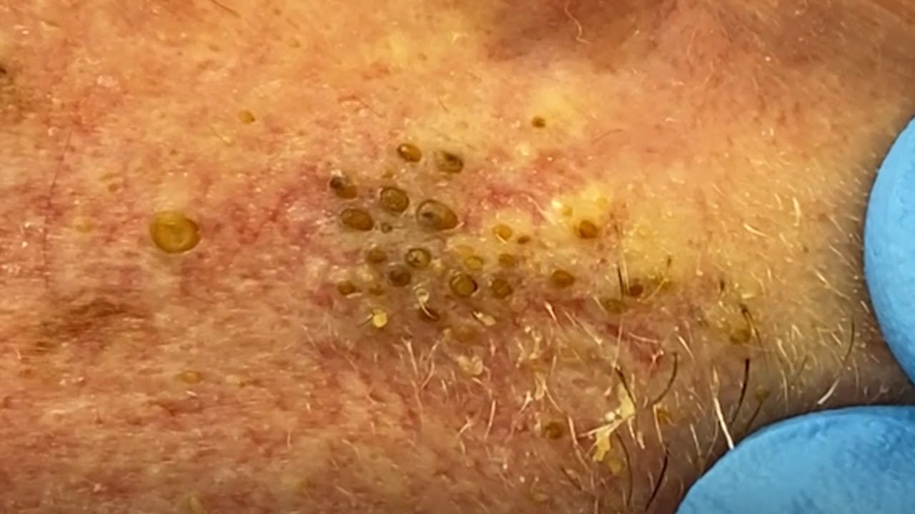 removing blackheads videos