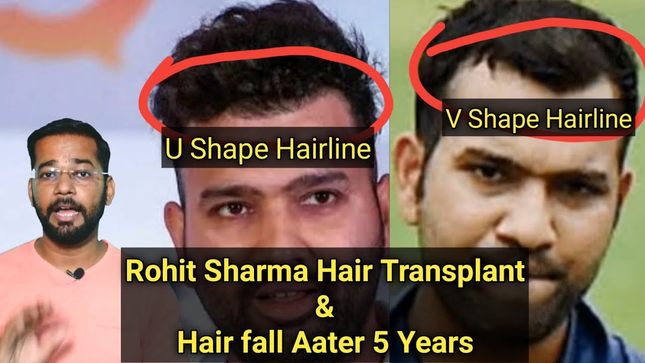 rohit sharma bald head