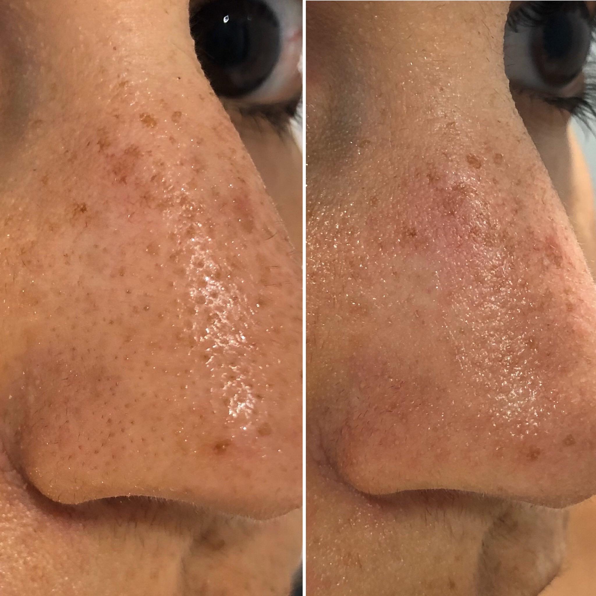 sebaceous filaments permanently stretched nose pore