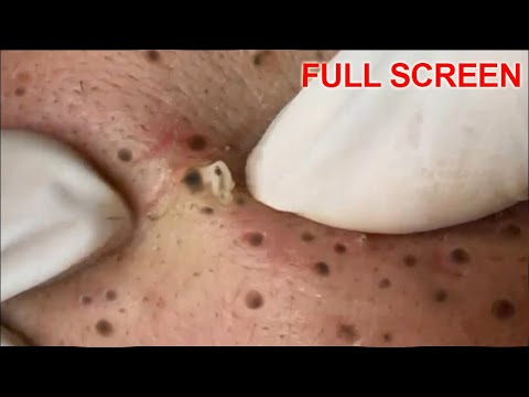 youtube spots and pimples